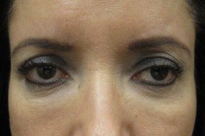 NYC browlift patient before surgery