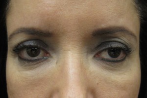 Brow Lift patient before