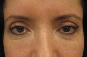 Results of NYC browlift treatment