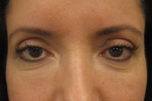 Brow Lift patient after