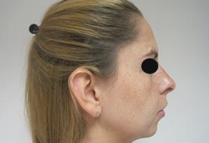 Before a chin implant from Dr. Cangello