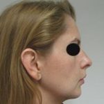 Results of a chin implant in NYC
