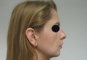 Results of a chin implant in NYC