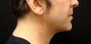 Chin Implant patient after