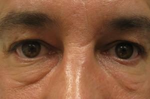 Puffy undereyes before blepharoplasty surgery