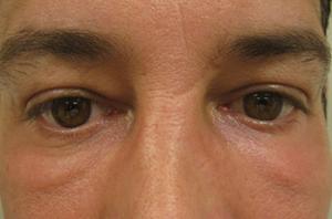 Blepharoplasty patient after