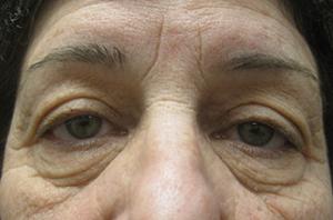 Blepharoplasty patient before