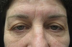 Results of an eyelid lift in NYC from Dr. Cangello