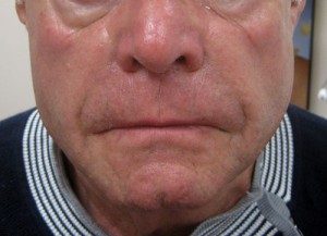 Patient before dermal filler treatment