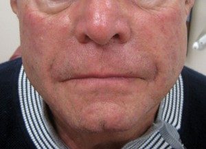 After dermal filler injections in NYC