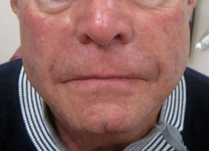 After dermal filler injections in NYC