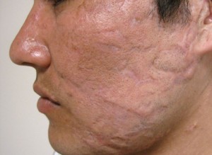 Laser Treatment patient after