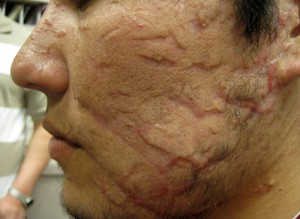 Laser Treatment patient before