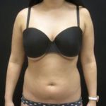 NYC liposuction patient before treatment