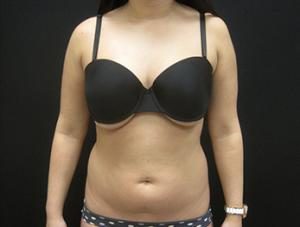 NYC liposuction patient before treatment