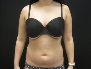Liposuction patient before