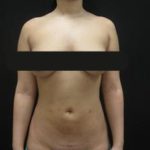 Results of NYC lipo with Dr. Cangello