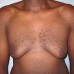 Patient before gynecomastia surgery