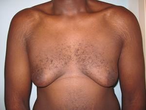 Patient before gynecomastia surgery