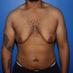 Before male breast reduction in NYC