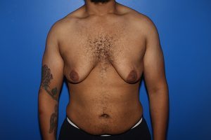 Before male breast reduction in NYC
