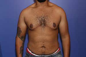 Breast Augmentation patient after