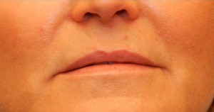 Patient before lip augmentation