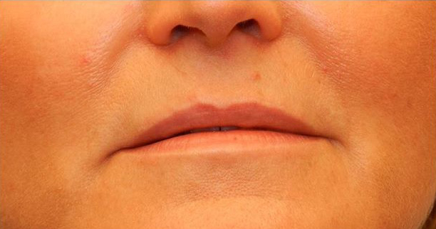Lip Augmentation patient before