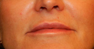 NYC lip augmentation results