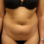 Before stomach liposuction in NYC