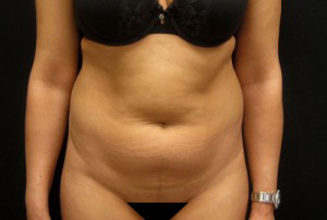 Liposuction patient before