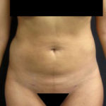 Results of abdominal lipo in NYC with Dr. Cangello