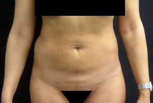 Liposuction patient after