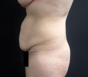 Tummy Tuck patient before