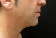 Male patient before chin augmentation