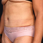 Dr. Cangello Tummy Tuck Procedure After Picture 1