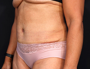 Dr. Cangello Tummy Tuck Procedure After Picture 1