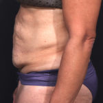 Dr. Cangello Tummy Tuck Procedure Before Picture 3