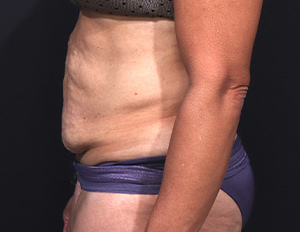 Dr. Cangello Tummy Tuck Procedure Before Picture 3