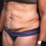 Dr. Cangello Tummy Tuck Procedure Before Picture 2