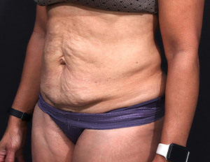 Dr. Cangello Tummy Tuck Procedure Before Picture 2