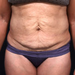 Dr. Cangello Tummy Tuck Procedure Before Picture 1
