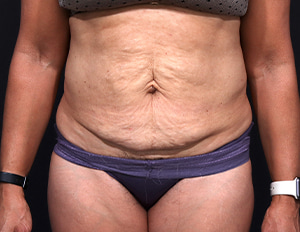 Dr. Cangello Tummy Tuck Procedure Before Picture 1