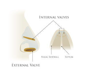 Spreader Grafting Figure 1