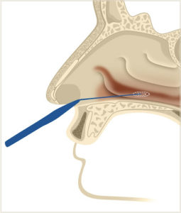 Figure 3. Enlarged turbinate.