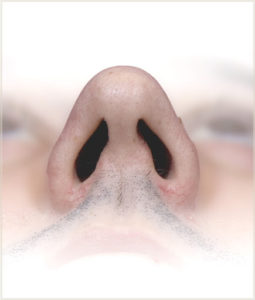 Figure 7. Subtotal Septal Resection Result, proximal view. Actual patient of Dr. Cangello’s.