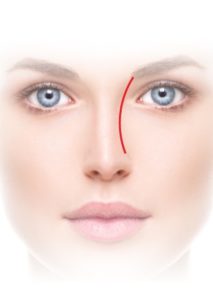 Brow tip aesthetic line.