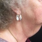 Before an NYC cosmetic neck lift