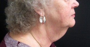 Neck Lift patient before