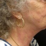 Results of a neck lift with Dr. Cangello